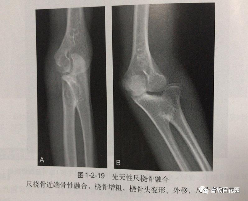 尺橈骨融合最新方法，探索前沿技術(shù)以優(yōu)化治療結(jié)果